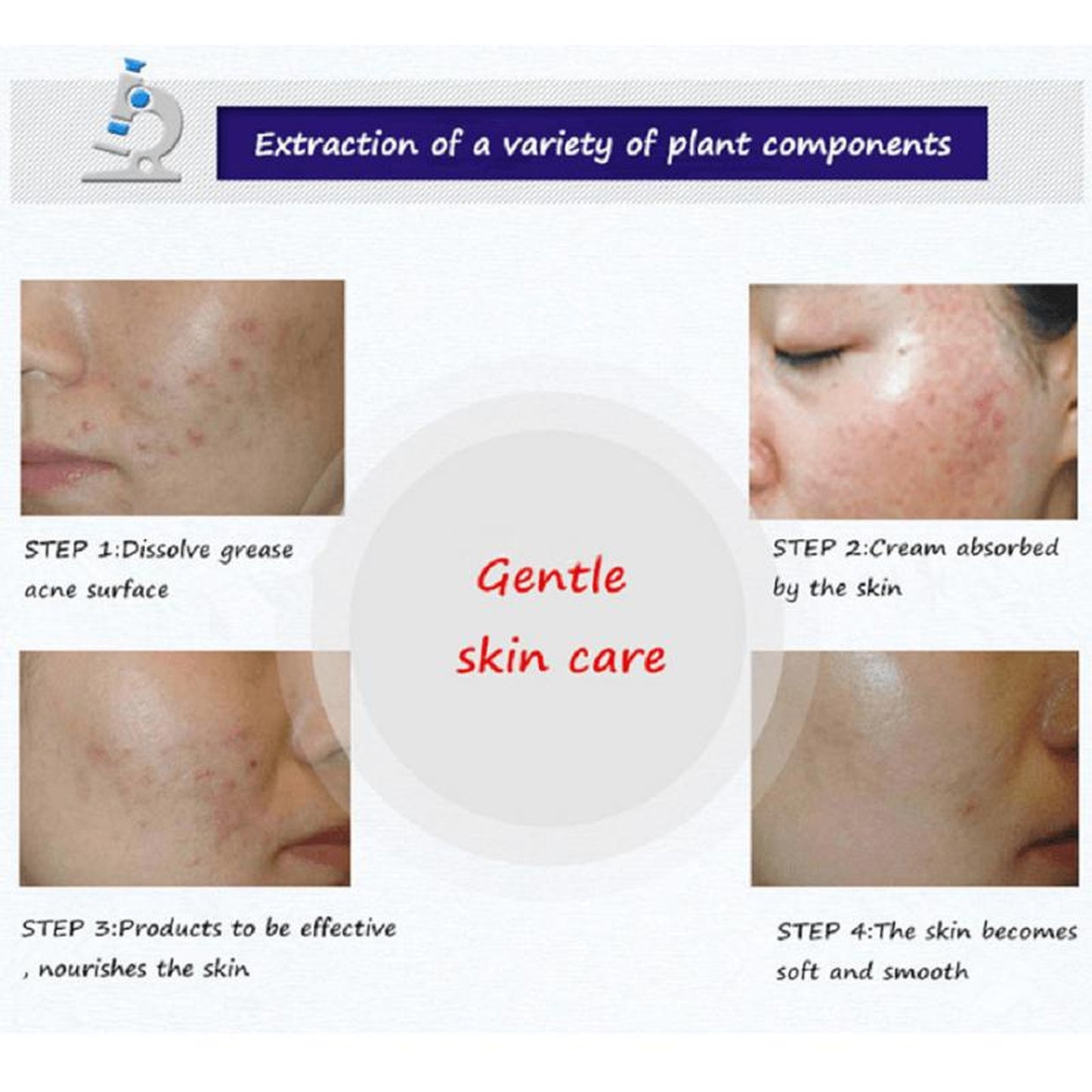 BIOAQUA Skin Delicate Silky Anti-Acne Gel | Oil Control & Pimple Treatment Cream